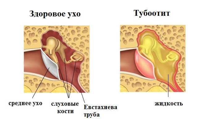 схема острого отита