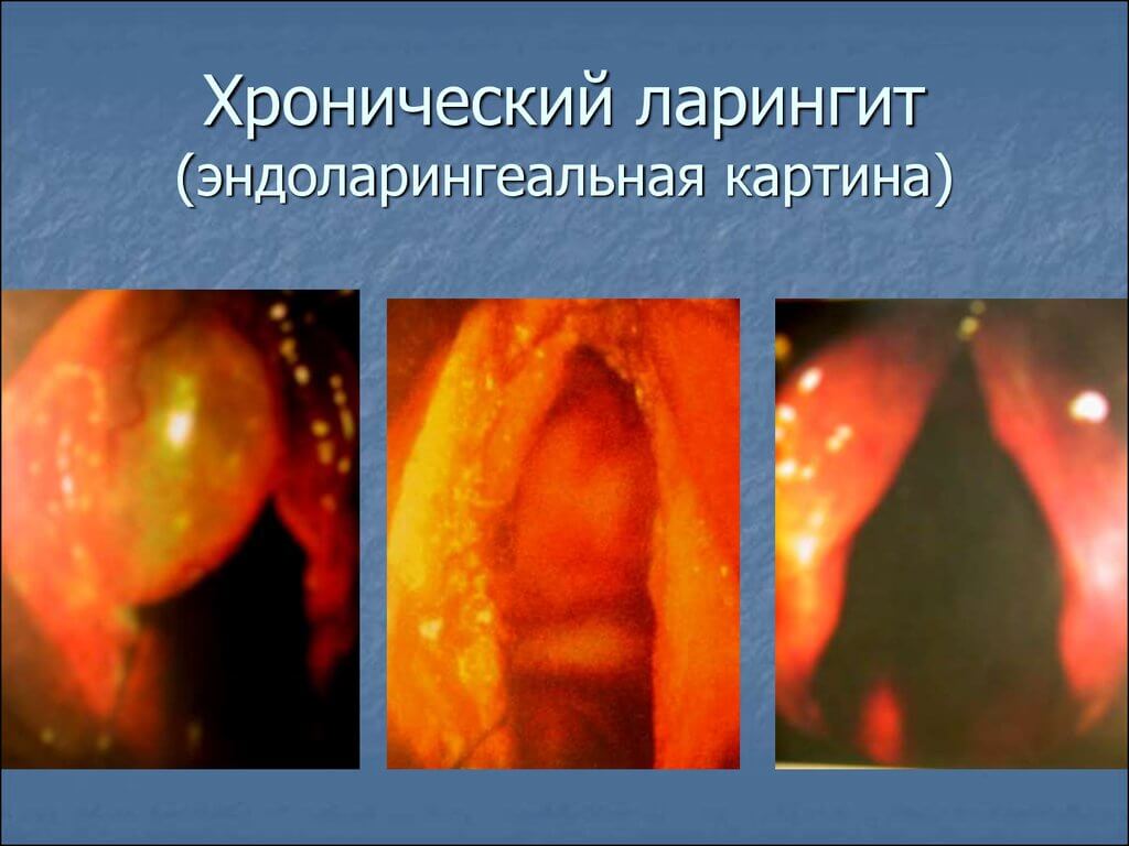 внешний вид ларингита