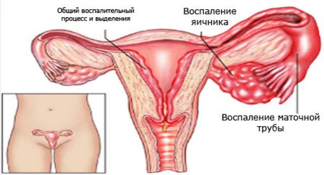 Симптомы воспаления яичников у женщин, лечение и профилактика
