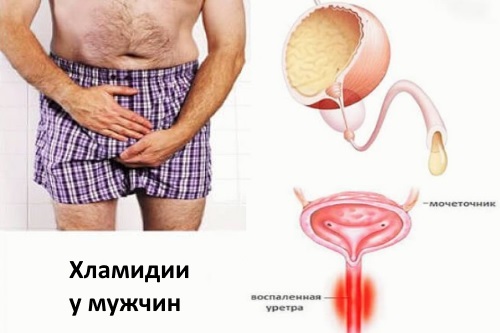 Как проявляется хламидиоз у мужчин