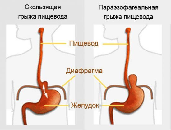 Грыжа пищевода, причины возникновения и методы лечения
