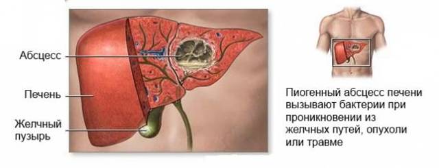 Что такое абсцесс печени: симптомы, причины и лечение