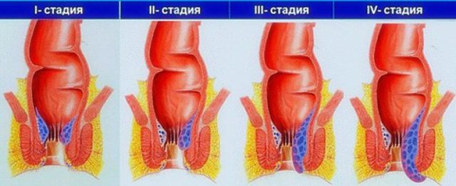 Как выглядит внутренний геморрой фото, первые симптомы и схема лечения