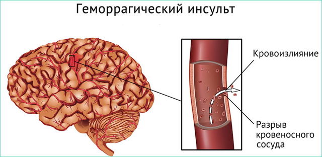 Геморрагический инсульт: что это такое? Симптомы, лечение и прогноз