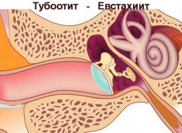 Евстахиит: что это такое? Симптомы и способы лечения