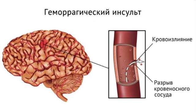 Геморрагический инсульт: что это такое? Симптомы, лечение и прогноз