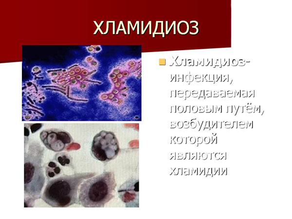Как проявляется хламидиоз у мужчин