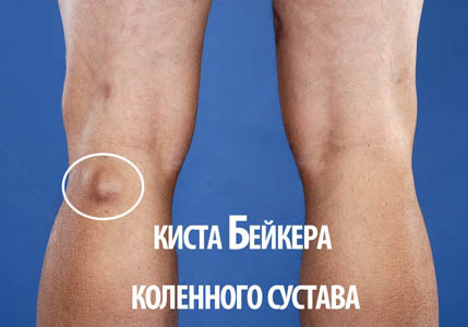 Киста бейкера коленного сустава: симптомы, причины и лечение