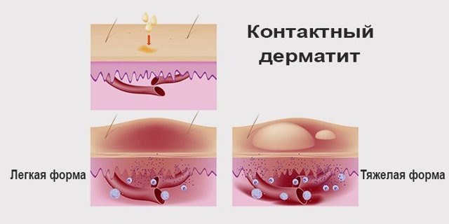 Лечение контактного дерматита, симптомы и подробные фото
