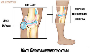 Киста бейкера коленного сустава: симптомы, причины и лечение