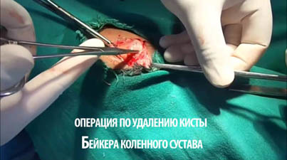 Киста бейкера коленного сустава: симптомы, причины и лечение