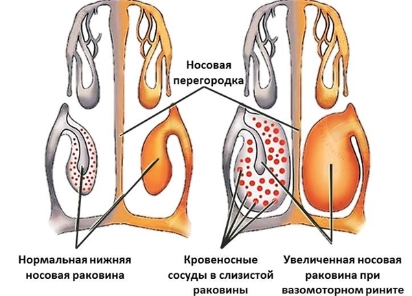 Что такое вазомоторный ринит? Симптомы и способы лечения