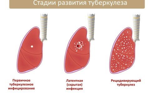 Туберкулез легких: симптомы, профилактика и способы лечения